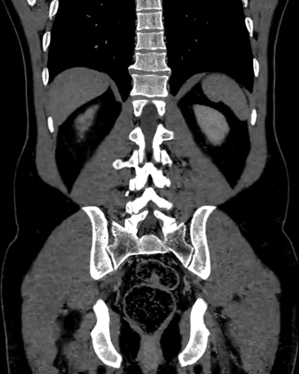 Coronal CT series scrolling through the thorax and abdomen